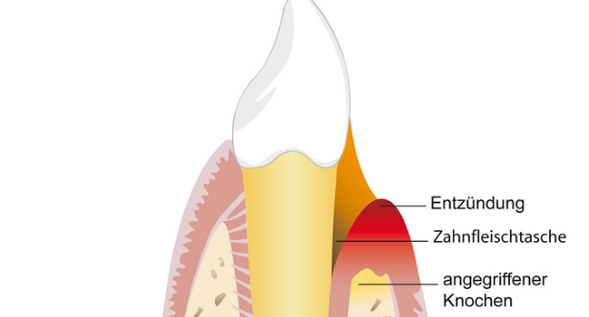 Schemazeichnung: Parodontitis